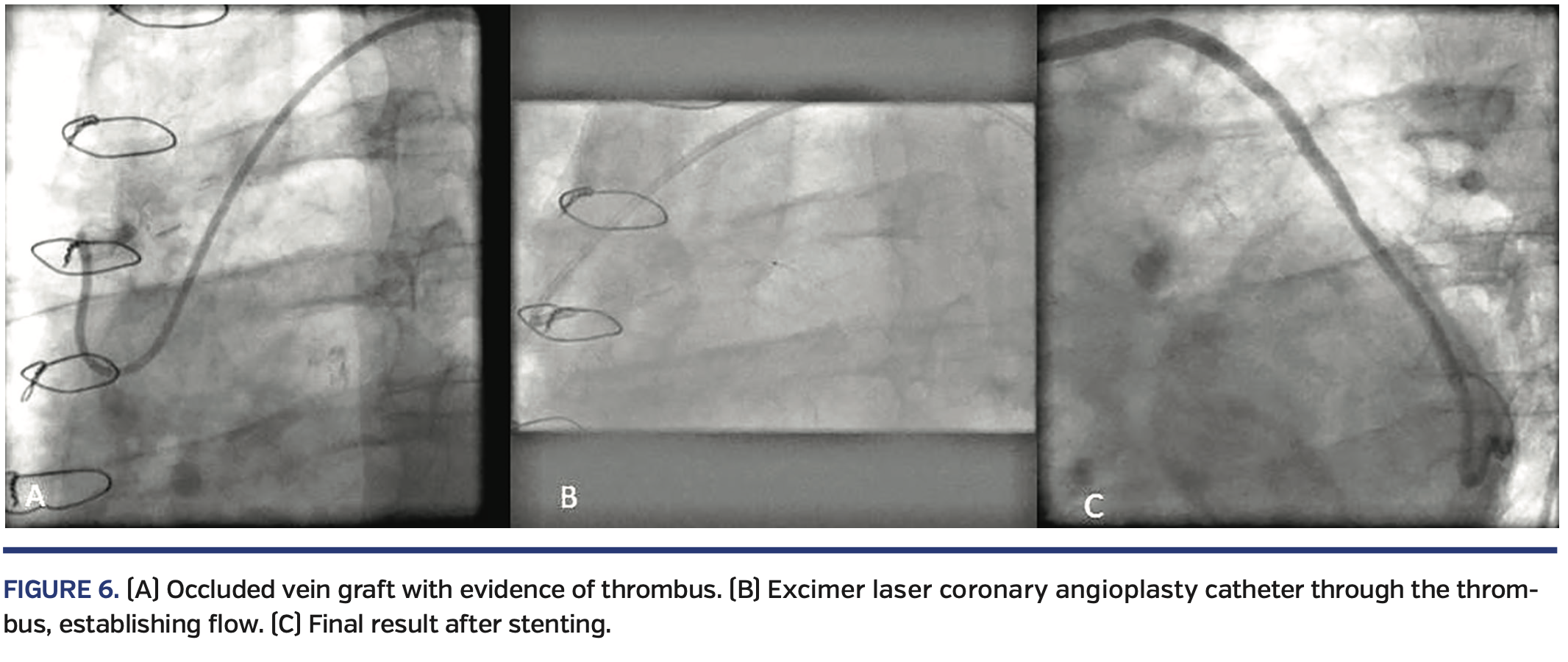 Excimer Laser Coronary Angioplasty (ELCA) Fundamentals, Mechanism of